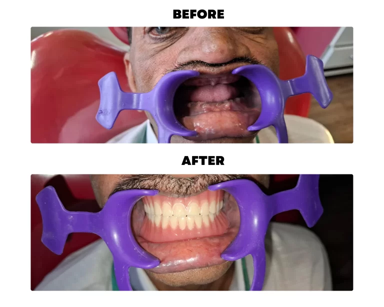 teeth recover 1