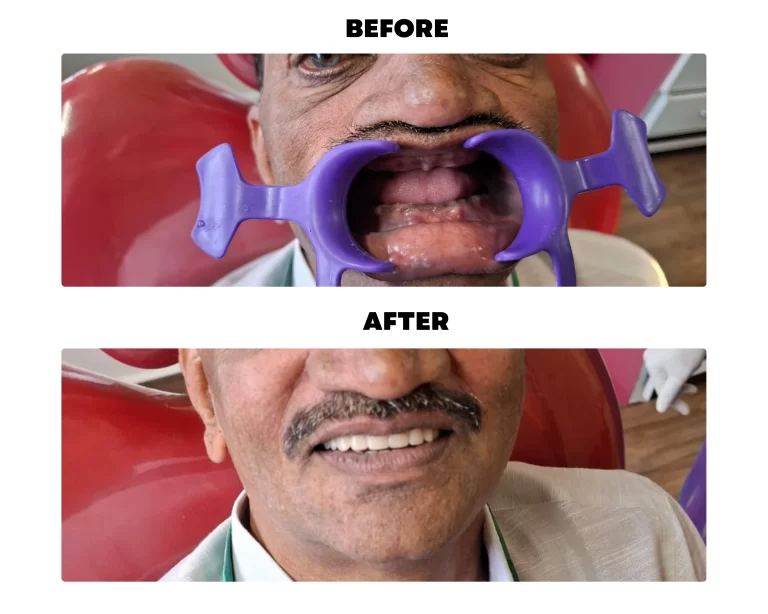 teeth recover